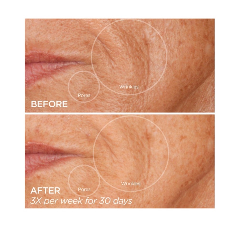 BEAUTYBIO GloPRO Facial Microneedling Tool - Picture 3 of 4